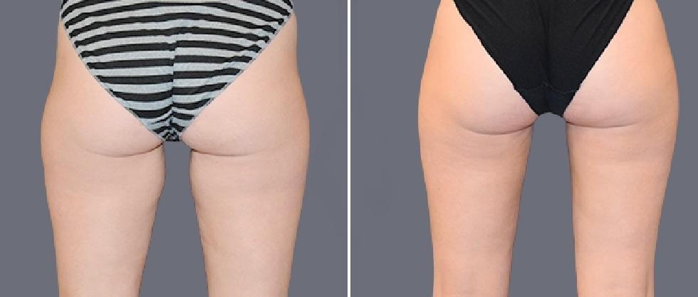 Leg Vaser Pre2024 005 Before And After