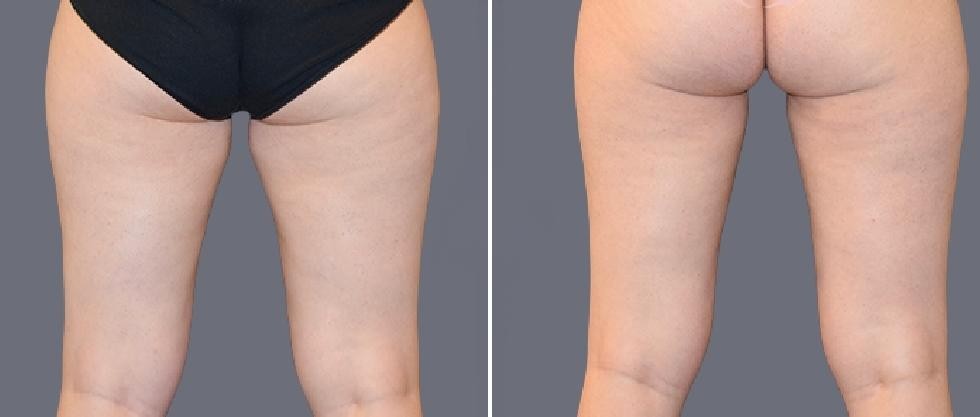 Leg Vaser Pre2024 006 Before And After