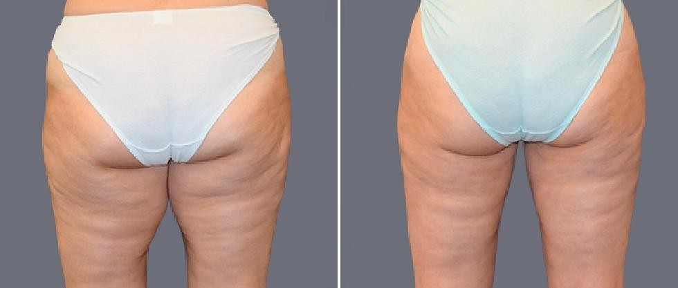Leg Vaser Pre2024 007 Before And After