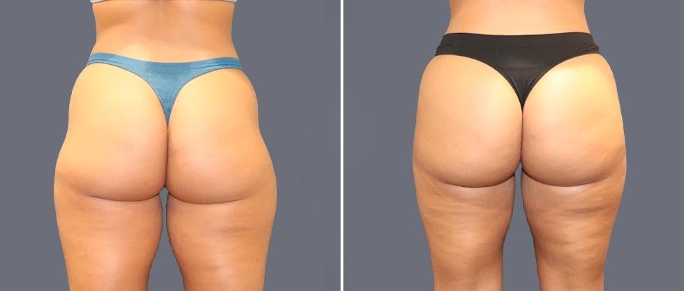 Leg Vaser Pre2024 008 Before And After