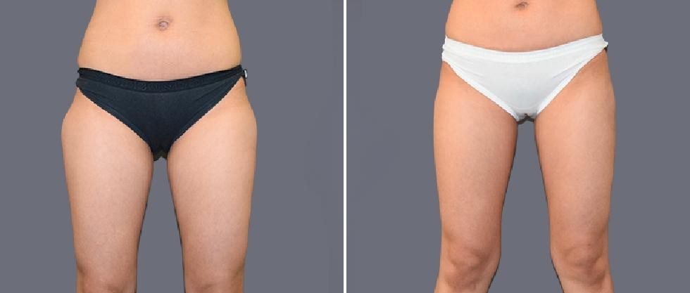 Leg Vaser Pre2024 009 Before And After