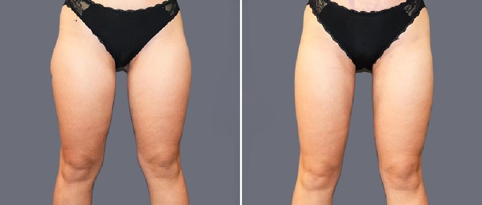 Leg Vaser Pre2024 010 Before And After