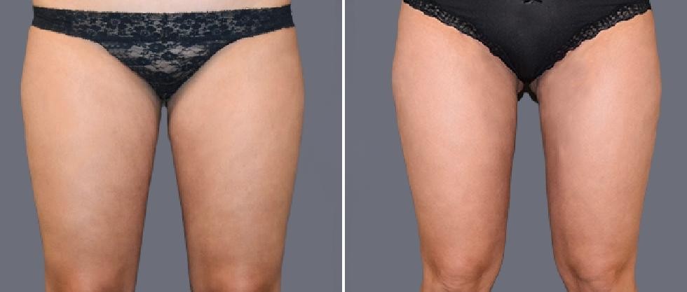 Leg Vaser Pre2024 011 Before And After