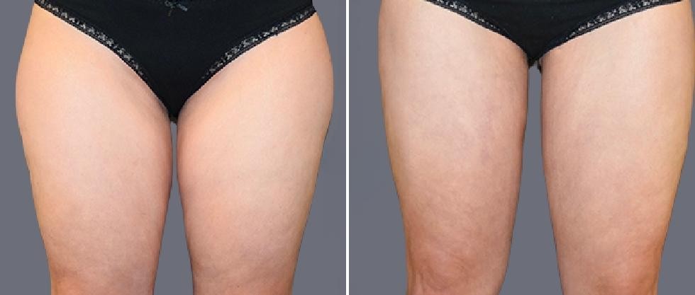 Leg Vaser Pre2024 012 Before And After