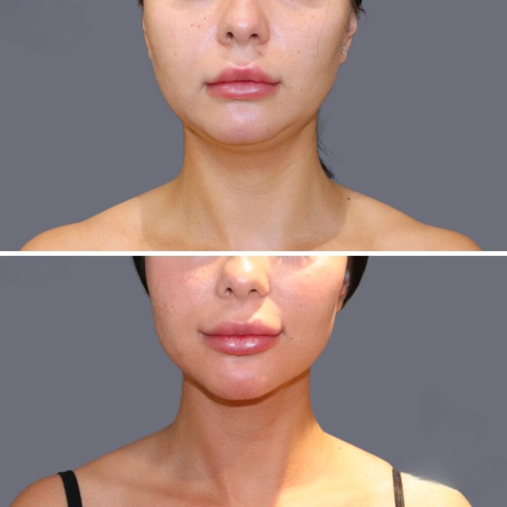 Lowerface Vaserliposuction Female Pre2024 001 Before And After