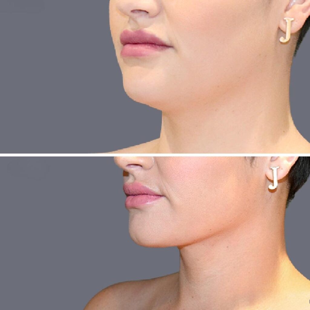 Lowerface Vaserliposuction Female Pre2024 002 Before And After