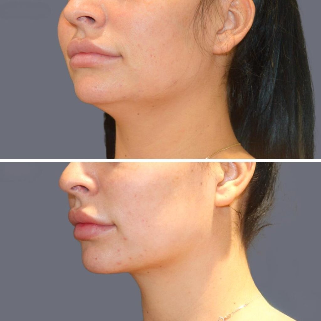 Lowerface Vaserliposuction Female Pre2024 003 Before And After