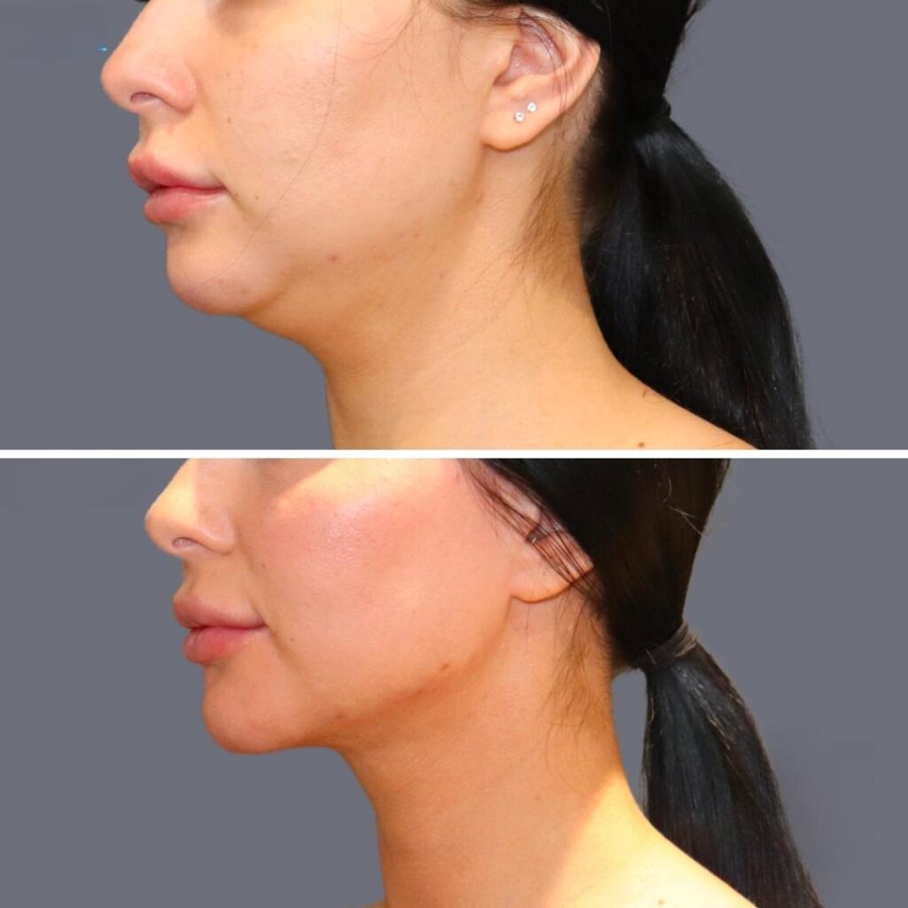 Lowerface Vaserliposuction Female Pre2024 004 Before And After