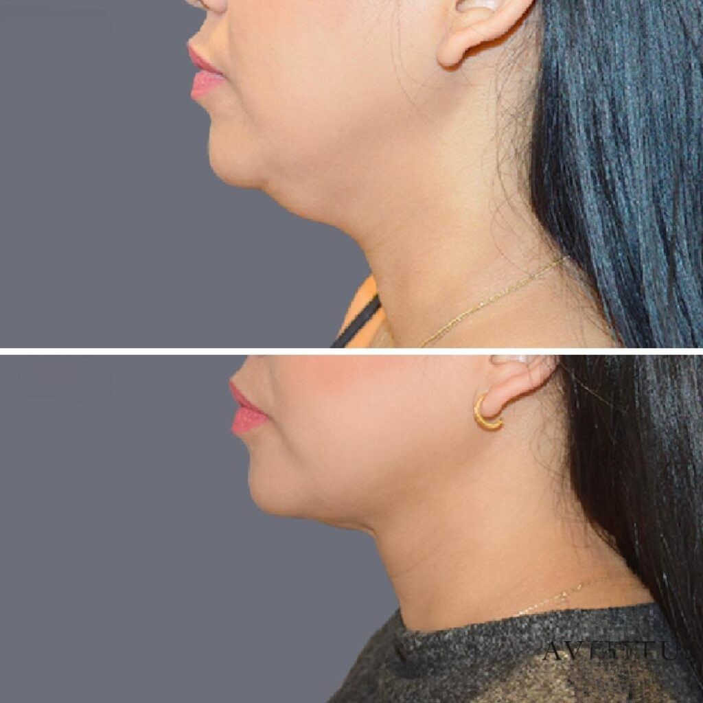 Lowerface Vaserliposuction Female Pre2024 005 Before And After