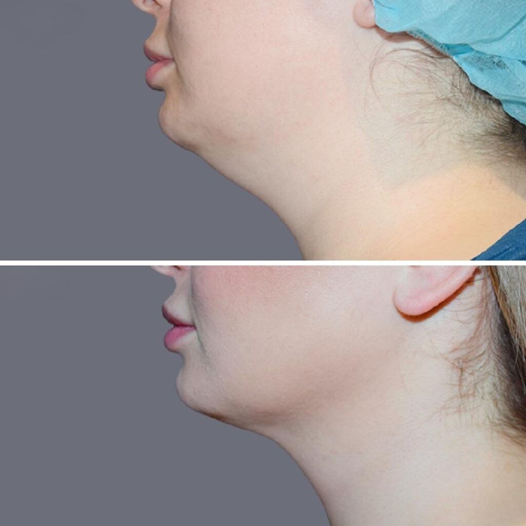 Lowerface Vaserliposuction Female Pre2024 007 Before And After