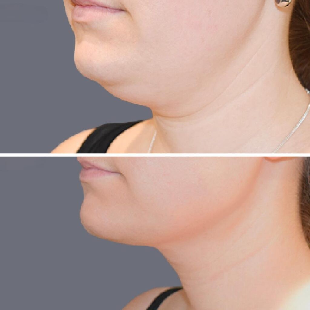 Lowerface Vaserliposuction Female Pre2024 008 Before And After