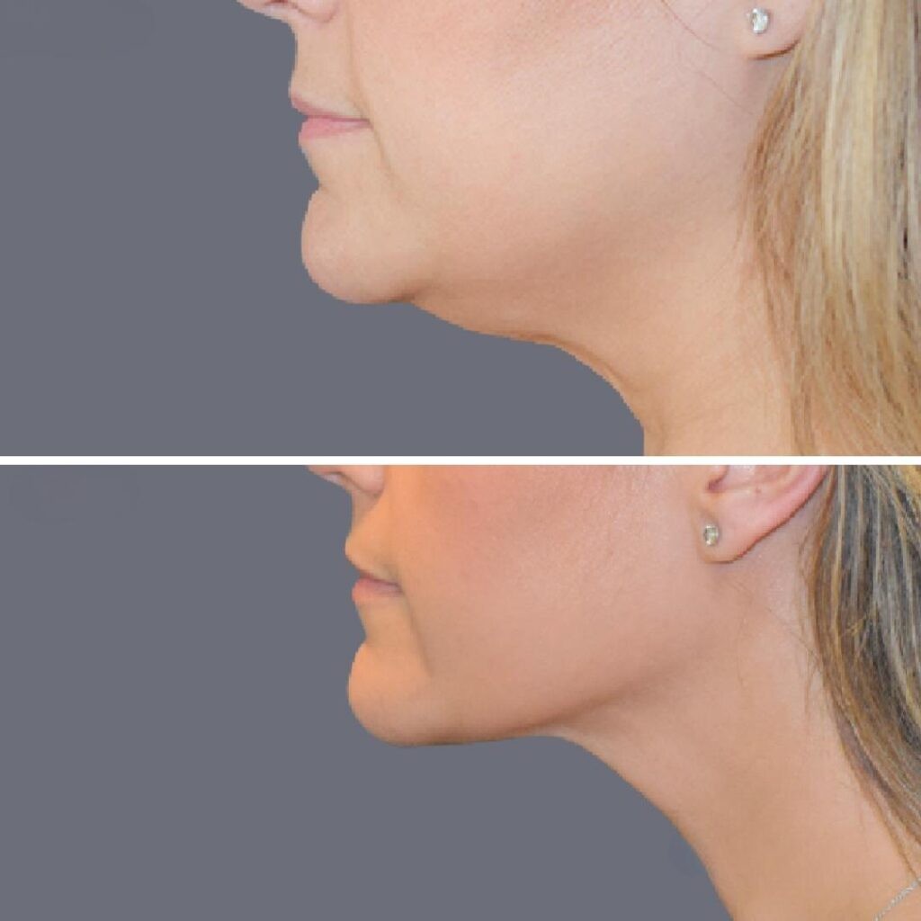 Lowerface Vaserliposuction Female Pre2024 009 Before And After