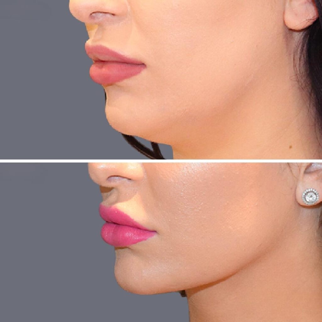 Lowerface Vaserliposuction Female Pre2024 010 Before And After