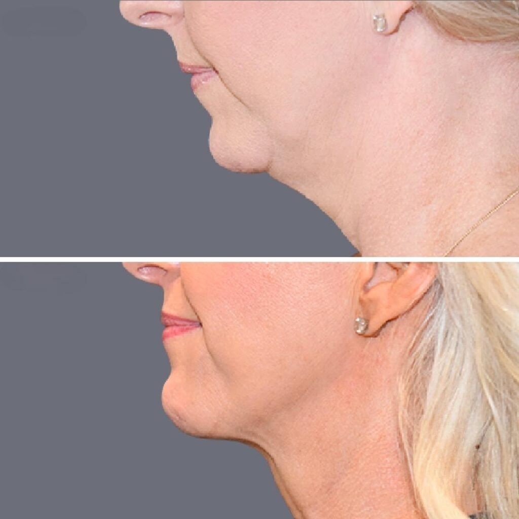 Lowerface Vaserliposuction Female Pre2024 011 Before And After
