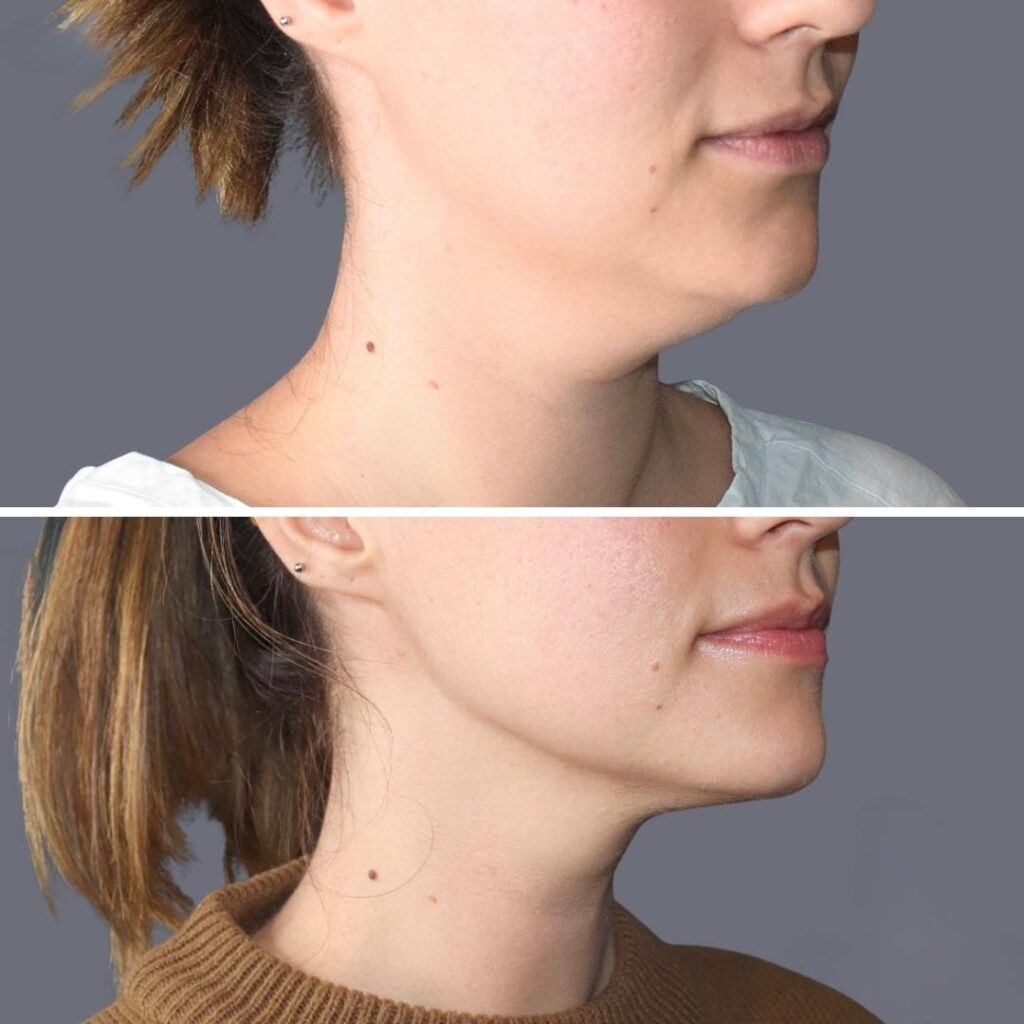 Lowerface Vaserliposuction Female Pre2024 012 Before And After