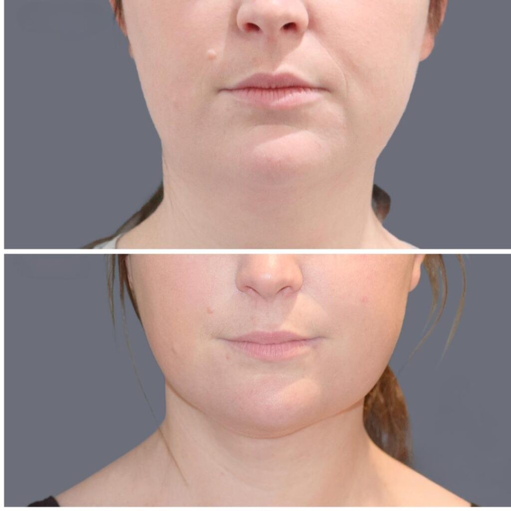 Lowerface Vaserliposuction Female Pre2024 015 Before And After