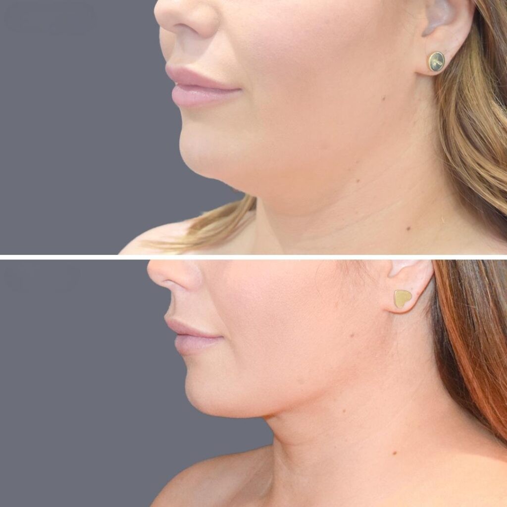 Lowerface Vaserliposuction Female Pre2024 016 Before And After