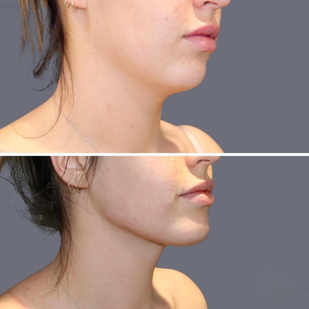 Lowerface Vaserliposuction Female Pre2024 017 Before And After