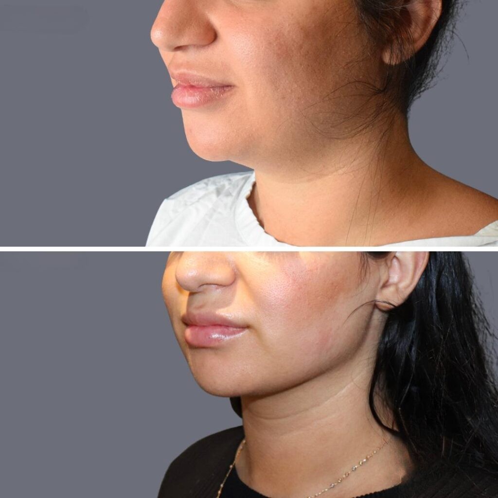 Lowerface Vaserliposuction Female Pre2024 018 Before And After
