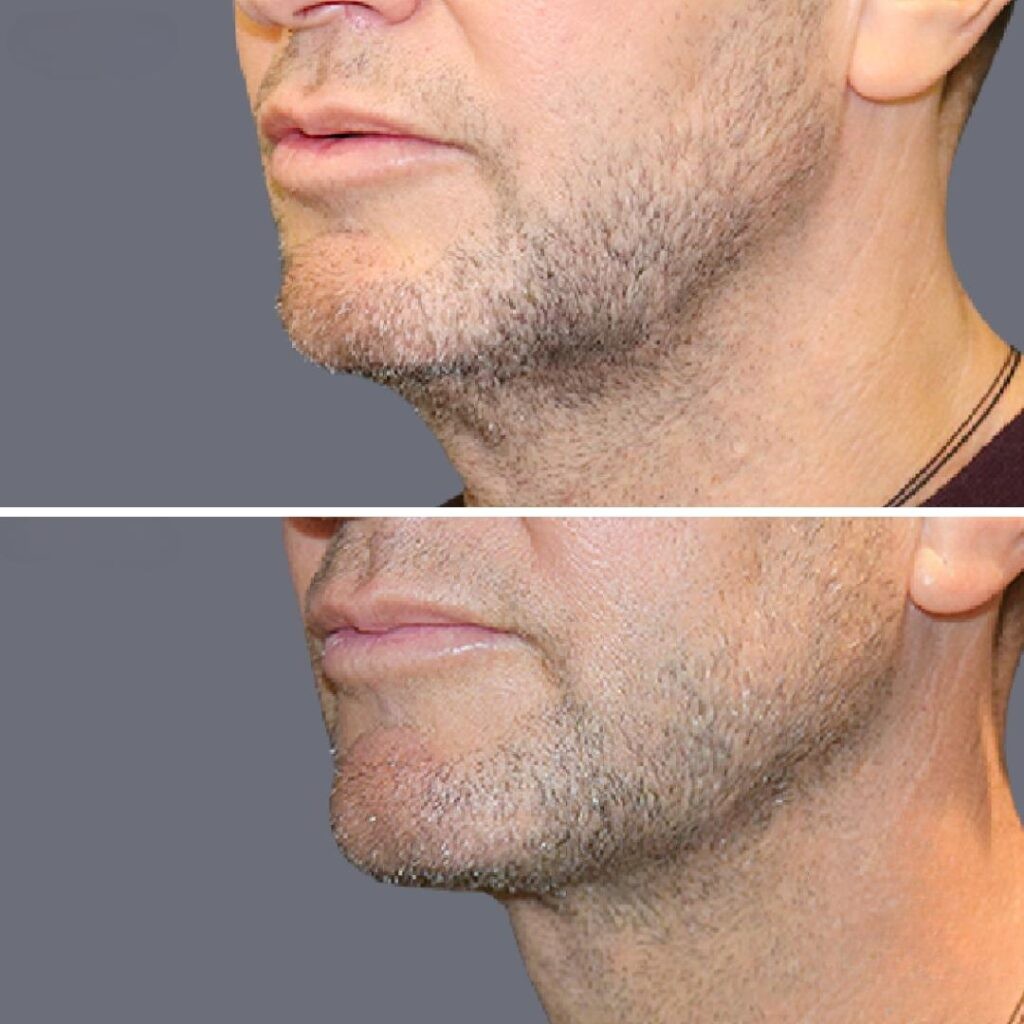 Lowerface Vaserliposuction Male Pre2024 006 Before And After