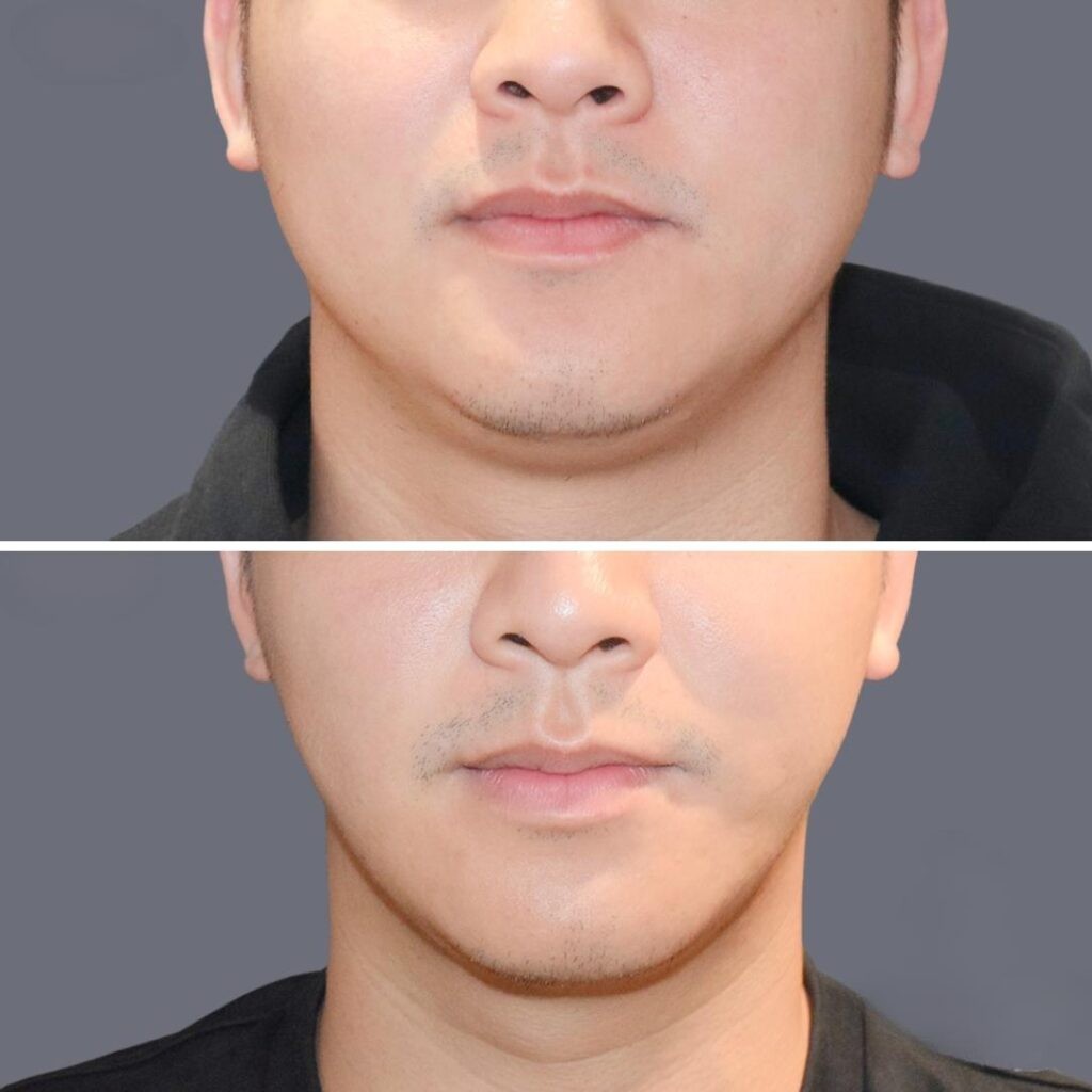 Lowerface Vaserliposuction Male Pre2024 013 Before And After