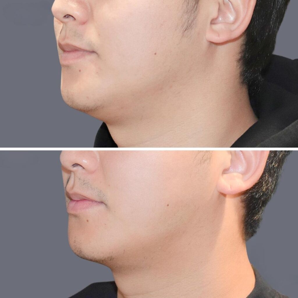 Lowerface Vaserliposuction Male Pre2024 014 Before And After