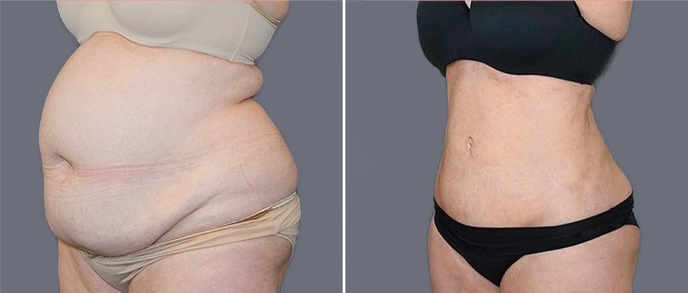 Mega Vaser Liposcution Female Pre2024 001 Before And After