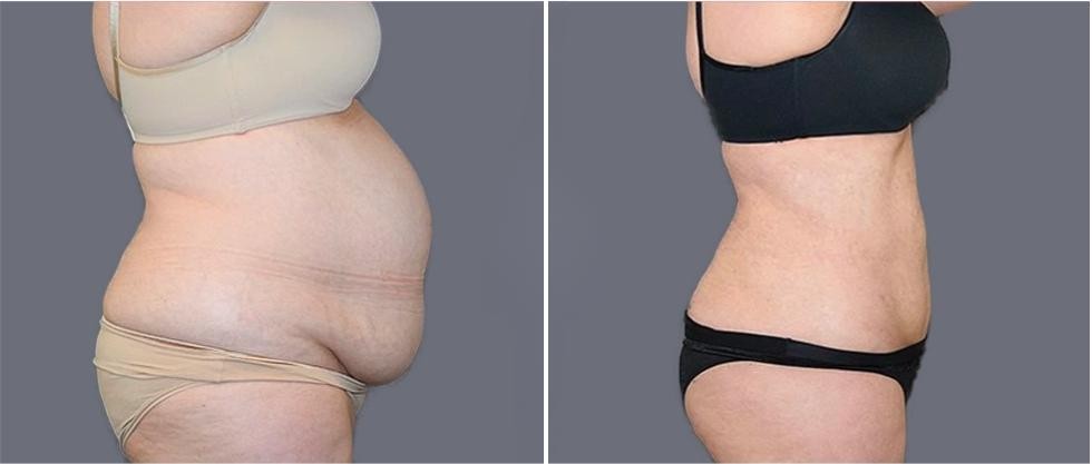 Mega Vaser Liposcution Female Pre2024 002 Before And After