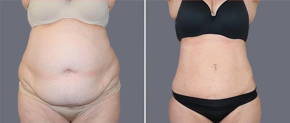 Mega Vaser Liposcution Female Pre2024 003 Before And After