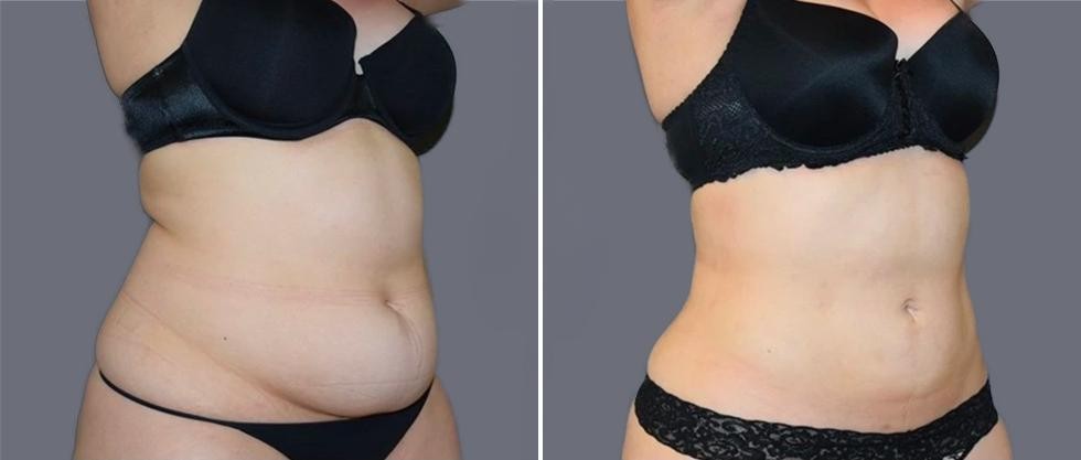 Mega Vaser Liposcution Female Pre2024 004 Before And After