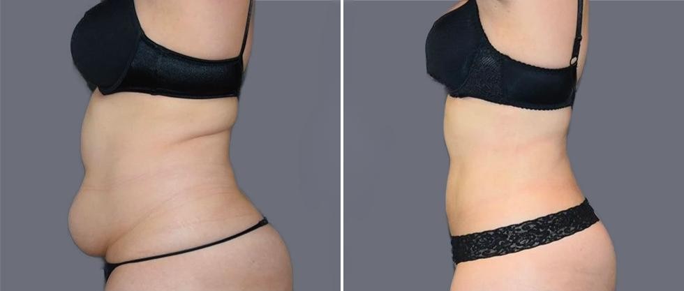 Mega Vaser Liposcution Female Pre2024 005 Before And After