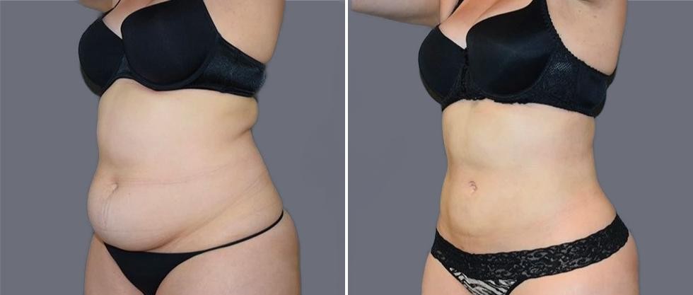 Mega Vaser Liposcution Female Pre2024 006 Before And After