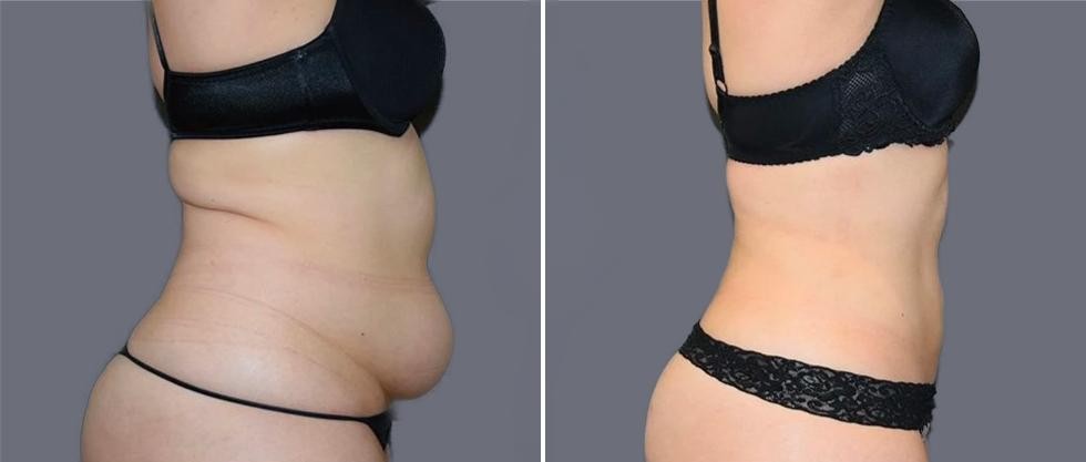 Mega Vaser Liposcution Female Pre2024 007 Before And After