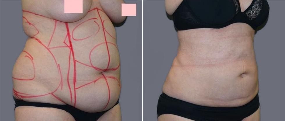 Mega Vaser Liposcution Female Pre2024 008 Before And After