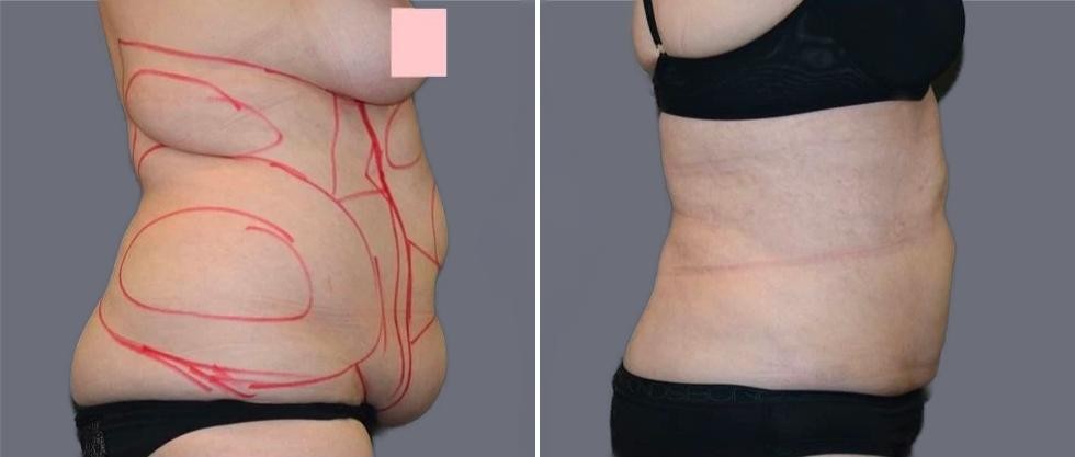Mega Vaser Liposcution Female Pre2024 009 Before And After