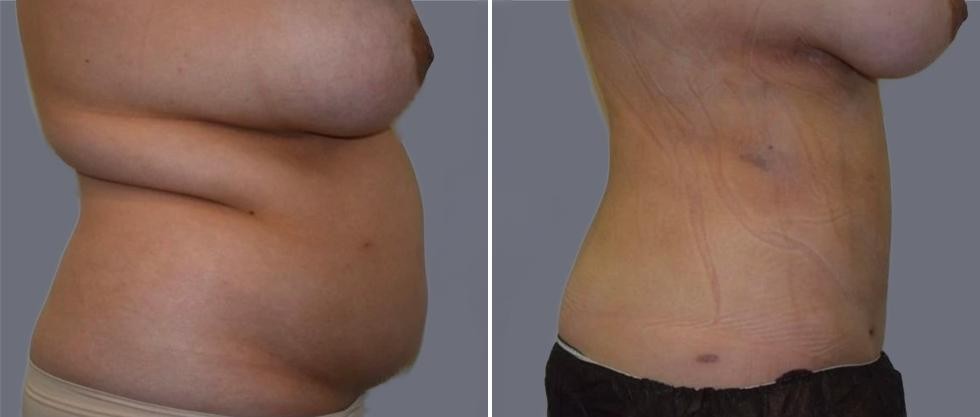 Mega Vaser Liposcution Female Pre2024 015 Before And After