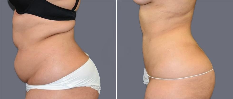 Mega Vaser Liposcution Female Pre2024 016 Before And After