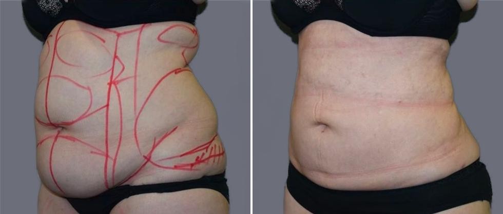 Mega Vaser Liposcution Female Pre2024 017 Before And After