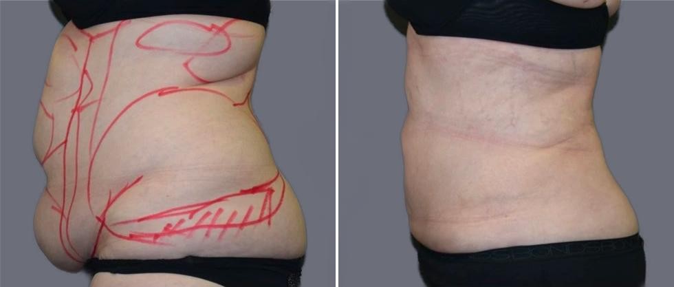 Mega Vaser Liposcution Female Pre2024 018 Before And After