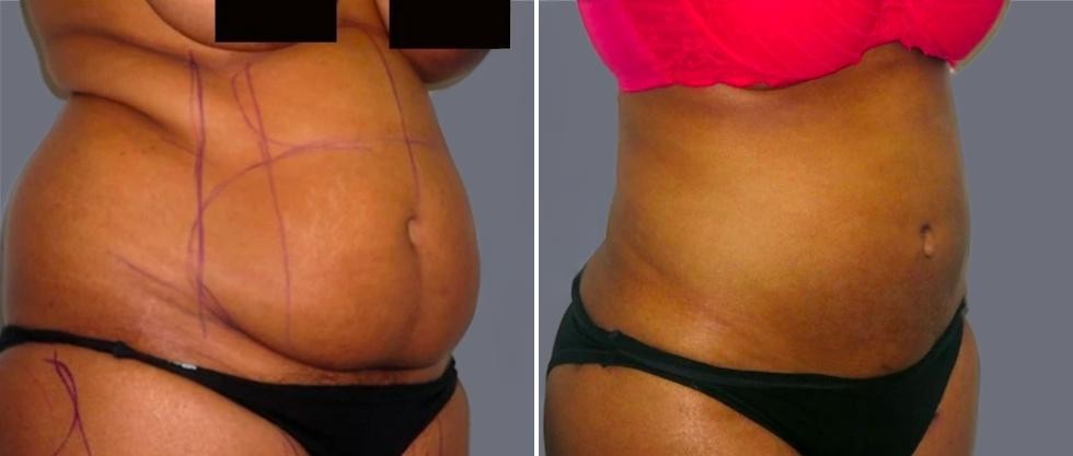 Mega Vaser Liposcution Female Pre2024 019 Before And After