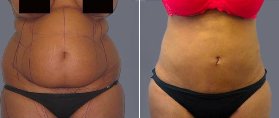 Mega Vaser Liposcution Female Pre2024 020 Before And After