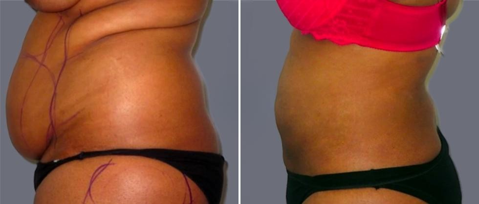 Mega Vaser Liposcution Female Pre2024 021 Before And After