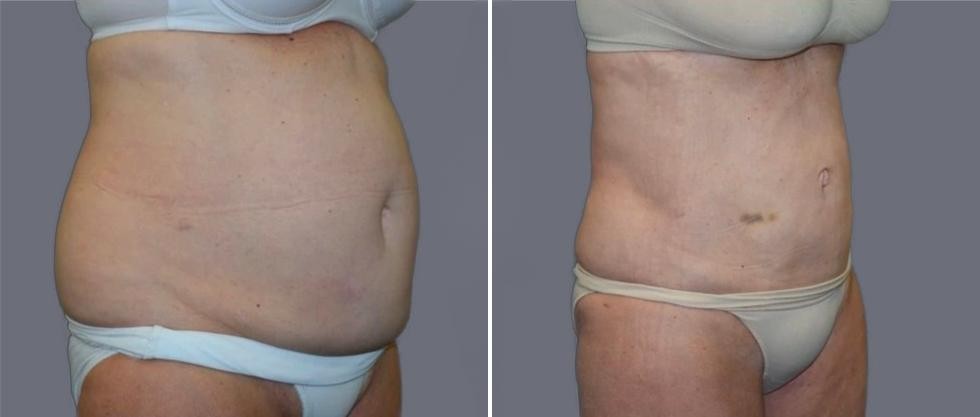 Mega Vaser Liposcution Female Pre2024 028 Before And After