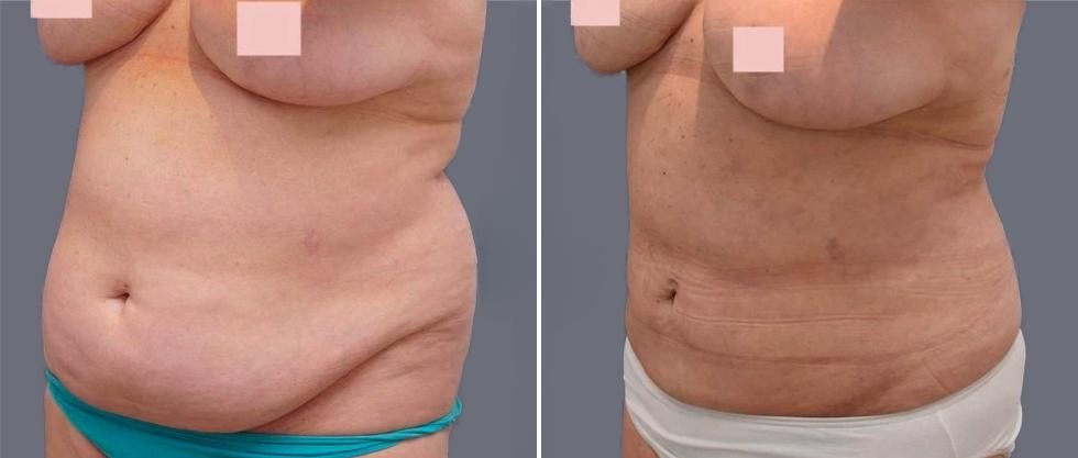 Mega Vaser Liposcution Female Pre2024 029 Before And After