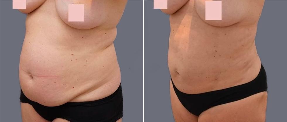 Mega Vaser Liposcution Female Pre2024 030 Before And After