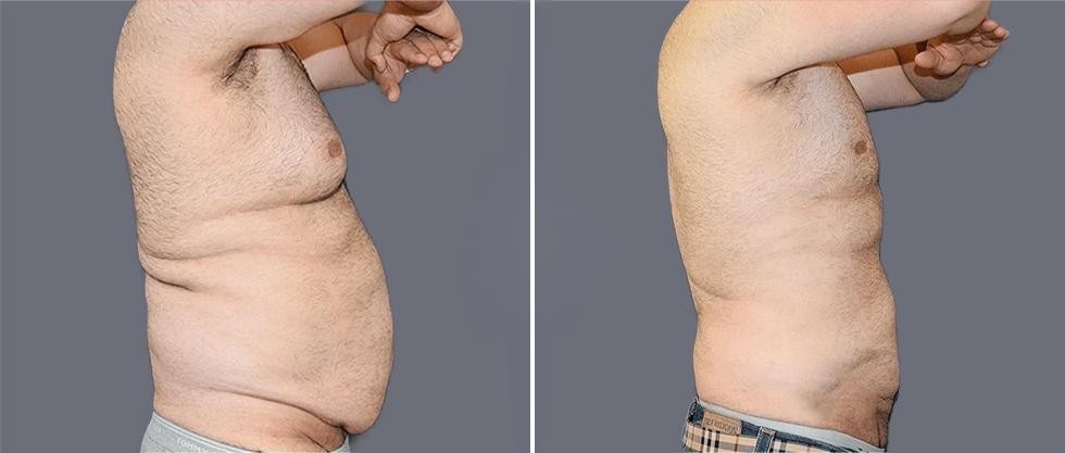 Mega Vaser Liposcution Male Pre2024 010 Before And After