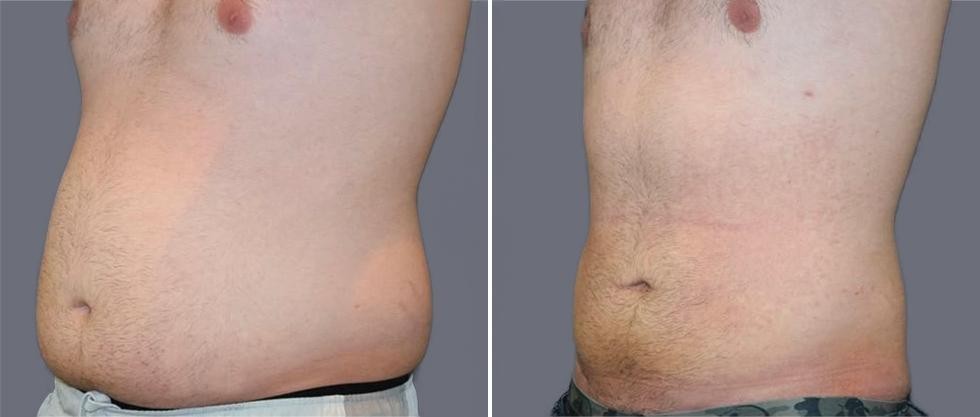 Mega Vaser Liposcution Male Pre2024 011 Before And After