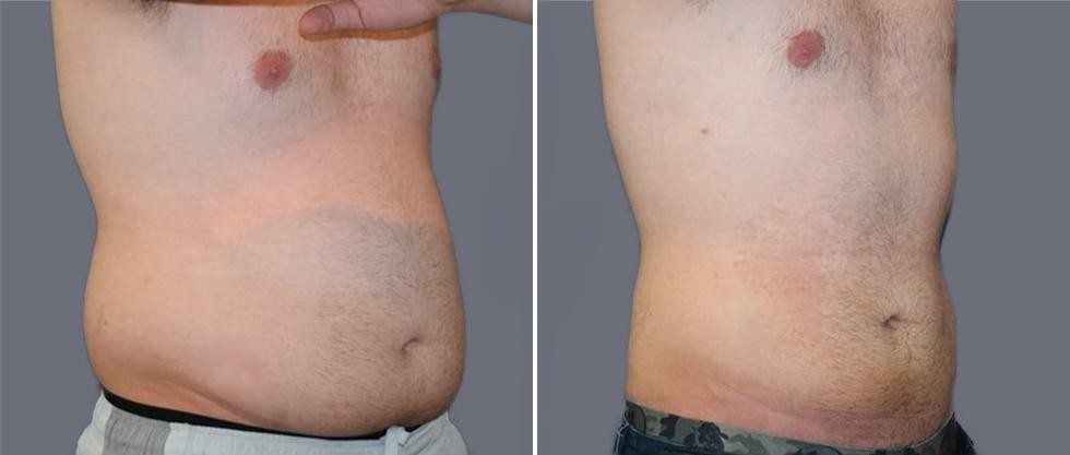 Mega Vaser Liposcution Male Pre2024 012 Before And After