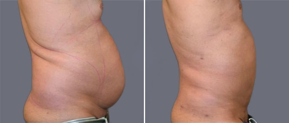 Mega Vaser Liposcution Male Pre2024 013 Before And After
