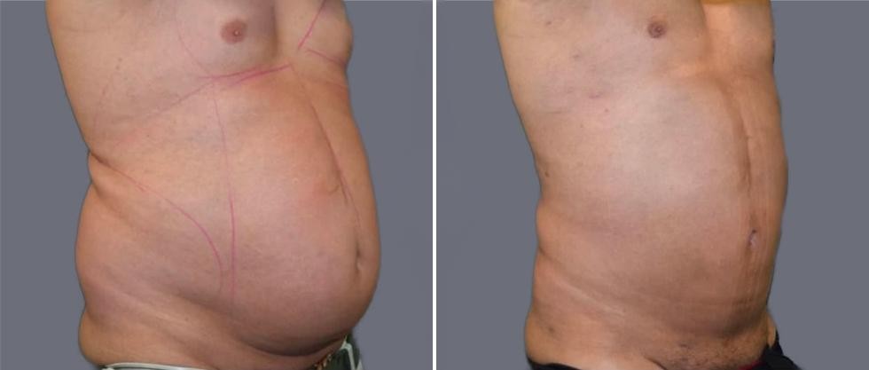 Mega Vaser Liposcution Male Pre2024 014 Before And After